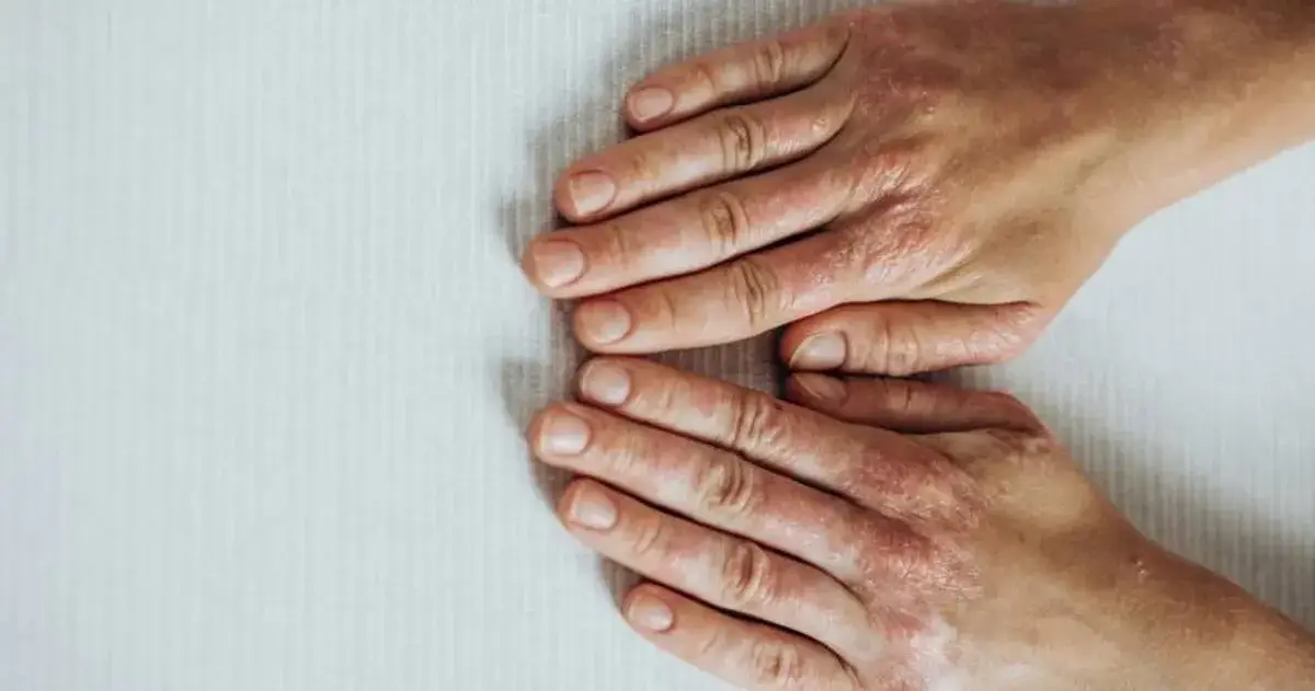 Signs of Psoriatic Arthritis & Why It's Important to Detect Them
